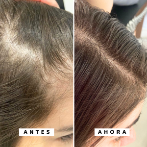Crecimiento y anticaída